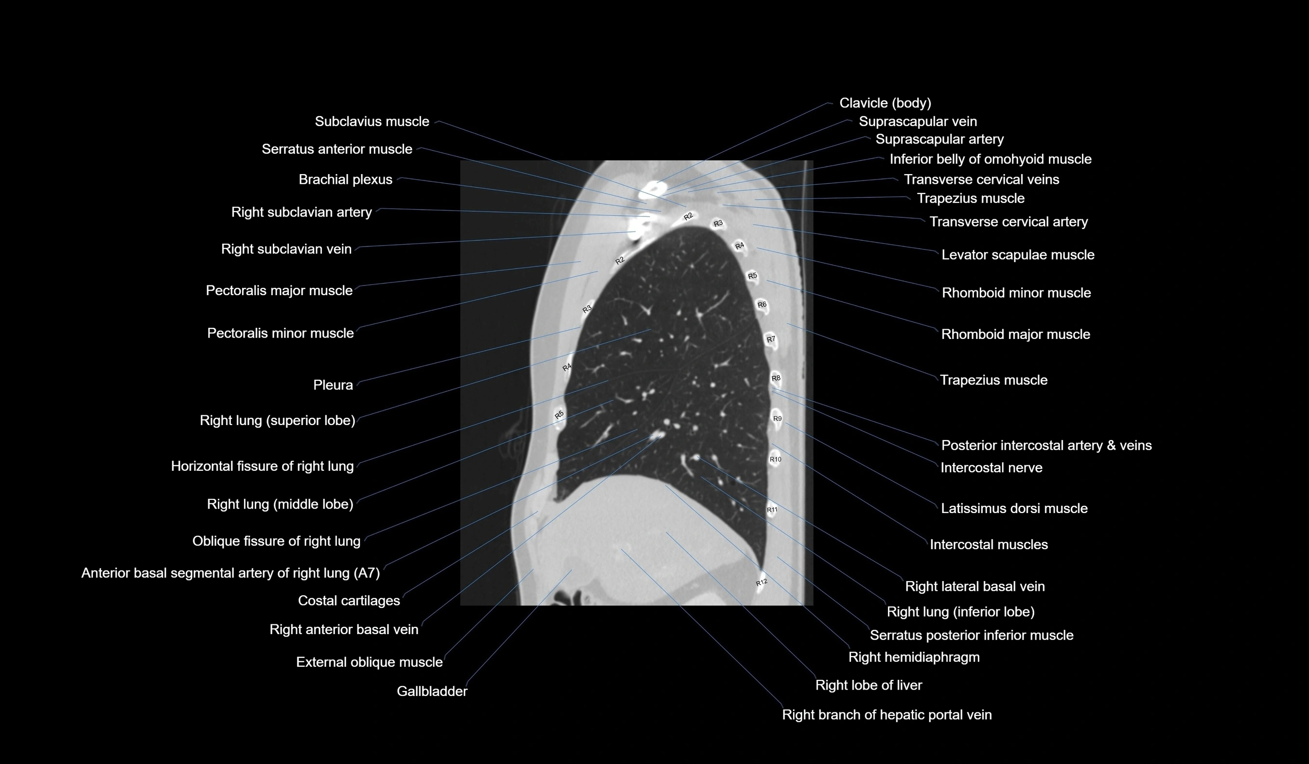 CT chest (thorax) lung window labelled sagittal cross sectional anatomy radiology image-00042.webp